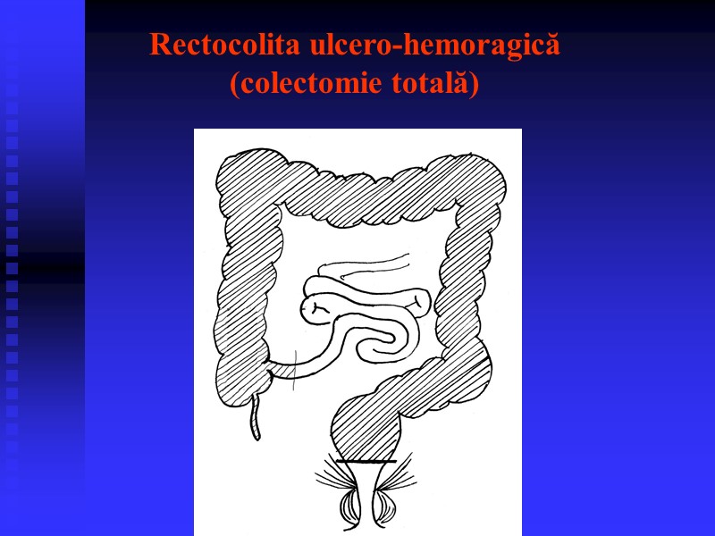 Rectocolita ulcero-hemoragică (colectomie totală)